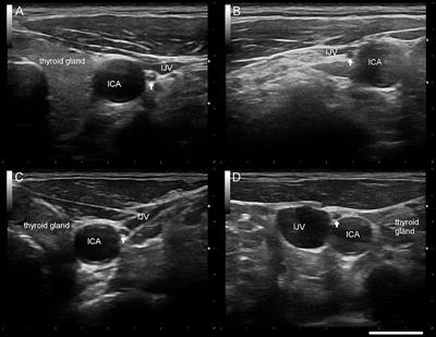 Axonal Degeneration of the Vagus Nerve in Parkinson's Disease—A High-Resolution <mark class="highlighted">Ultrasound Study</mark>